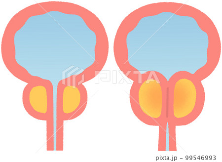 正常な前立腺と肥大した前立腺 99546993