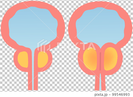正常な前立腺と肥大した前立腺 99546993