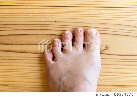 小指が寝指になっている中高年女性の足 99558670