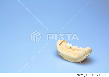 歯科石膏 99571295