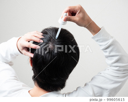 育毛剤を塗る男性　後頭部　髪の毛 99605615