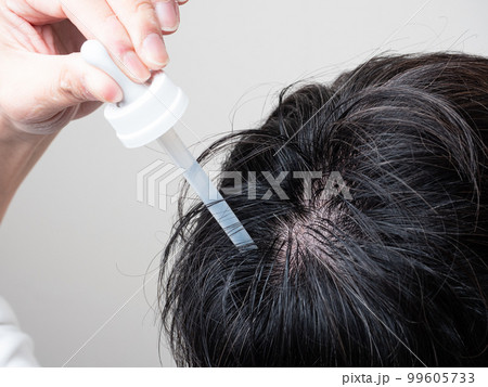 育毛剤を塗る男性 つむじ 髪の毛 育毛剤を塗る男性 つむじ 髪の毛 99605733