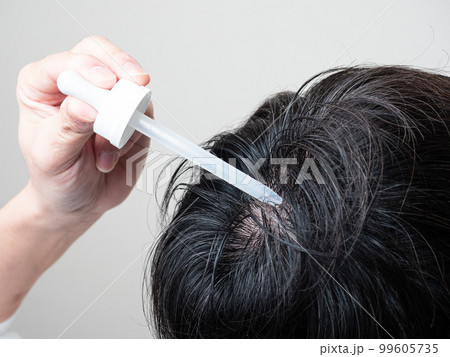 育毛剤を塗る男性　つむじ　髪の毛 99605735