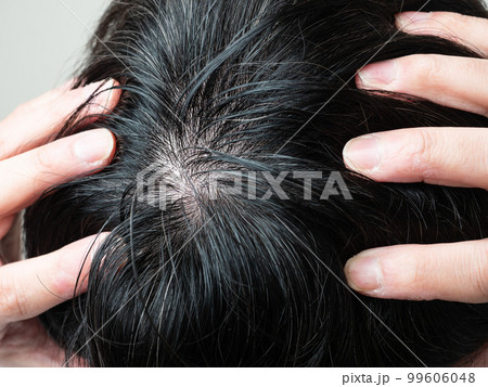男性の髪の毛　つむじのアップ 99606048