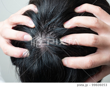 男性の髪の毛 つむじのアップ 男性の髪の毛 つむじのアップ 99606053