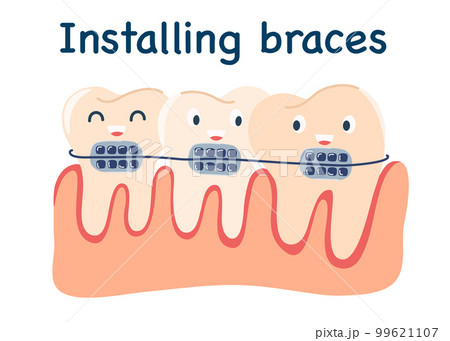 0127_braces 99621107