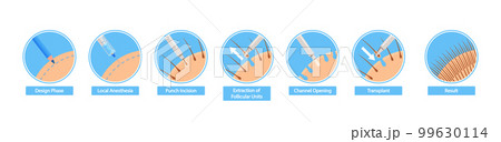 Hair Transplantation Procedure In Progress Infographic Stages. Design Phase, Local Anesthesia, Punch Incision Hair Transplantation Procedure In Progress Infographic Stages. Design Phase, Local Anesthesia, Punch Incision 99630114