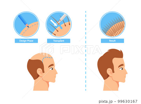 Hair Transplantation Process Infographics Including Design Phase, Transplant and Result Stages. Before and After Images Hair Transplantation Process Infographics Including Design Phase, Transplant and Result Stages. Before and After Images 99630167