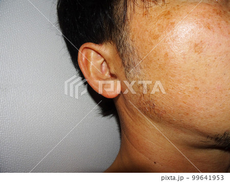 顔のシミ(男性) 顔のシミ(男性) 99641953