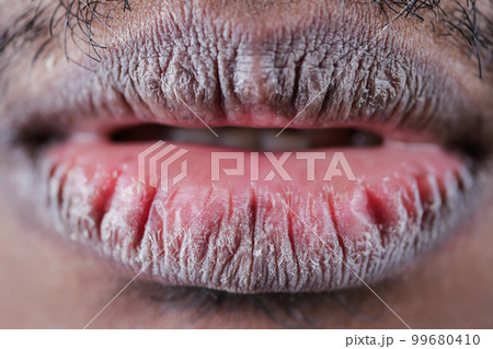 Close up of dry lip of a young men Close up of dry lip of a young men 99680410