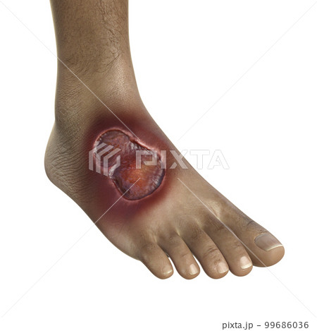 Buruli ulcer, a chronic debilitating disease affecting skin and subcutaneous tissues found mainly in tropical and subtropical countries caused by bacteria Mycobacterium ulcerans, 3D illustration Buruli ulcer, a chronic debilitating disease affecting skin and subcutaneous tissues found mainly in tropical and subtropical countries caused by bacteria Mycobacterium ulcerans, 3D illustration 99686036