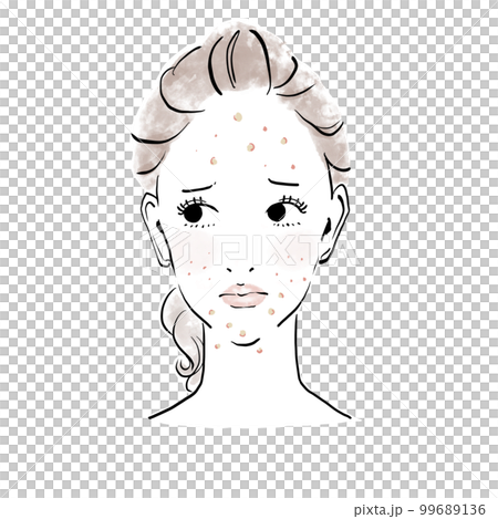 スキンケアイメージ　ニキビを気にする女性 99689136