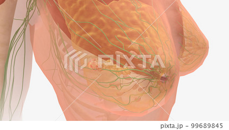 Stage III breast tumors are invasive and have spread to the lymph nodes around the collar bone or those deep within the breast. 99689845
