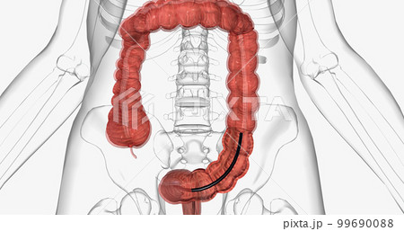 Colonoscopy is an invasive procedure used to look inside the large intestines. 99690088