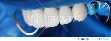 Installation of veneers and dental implants in clinic closeup 99713205