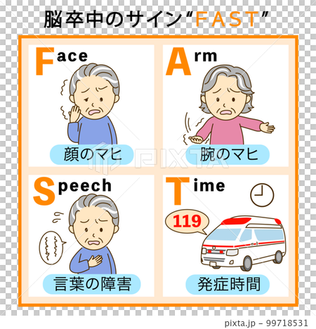 Stroke check FAST explanation illustration 1 99718531