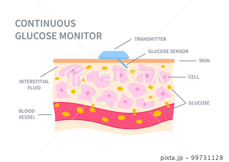 Continuous glucose monitor sensor in skin illustration 99731128