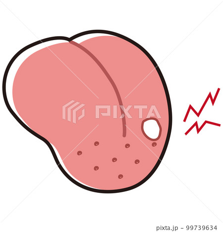 口内炎ができた舌のイラスト 99739634
