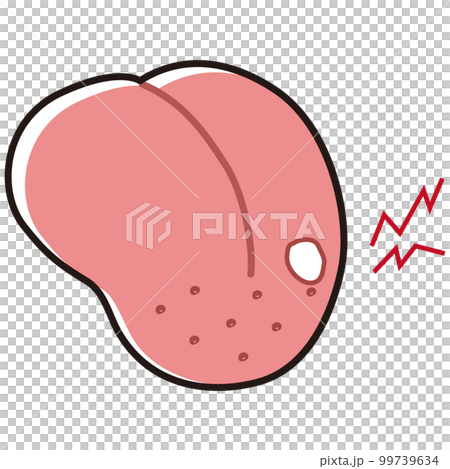 口内炎ができた舌のイラスト 99739634