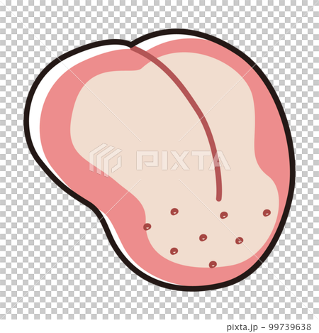 白くなった舌(舌苔、舌癌)のイラスト 白くなった舌(舌苔、舌癌)のイラスト 99739638