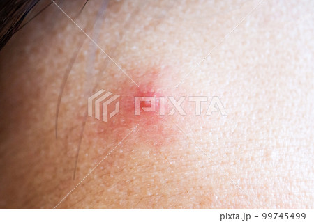 Inflammatory acne with red spot on face closeup Inflammatory acne with red spot on face closeup 99745499