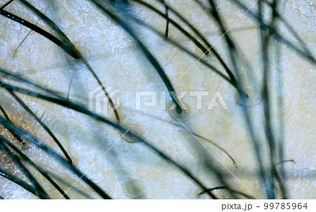 マイクロスコープ　頭皮　拡大　薄毛 99785964