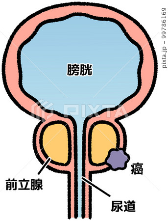 前立腺がん(名称あり) 前立腺がん(名称あり) 99786169