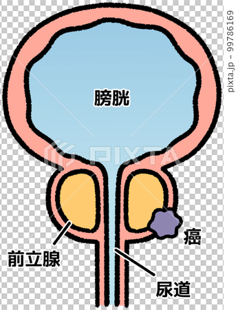 前立腺がん(名称あり) 前立腺がん(名称あり) 99786169