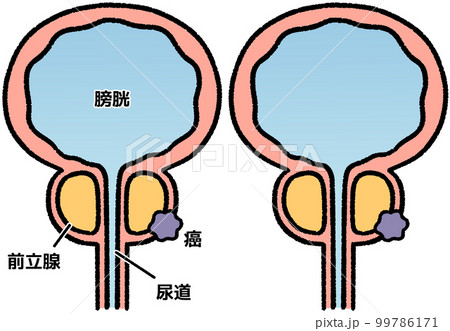 前立腺がん 99786171