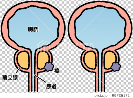 前立腺がん 99786171