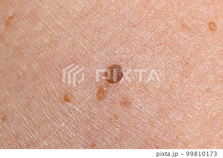 Papilloma on human skin - benign tumor in the form of mole, nevus Papillomatosis medicine 99810173