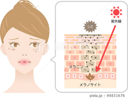 シミのしくみと紫外線　女性　肌の断面図 99831676