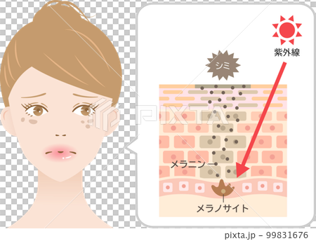 シミのしくみと紫外線　女性　肌の断面図 99831676