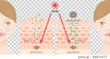 Mechanism of blemishes and UV rays A cross-sectional view of a woman's skin before and after Mechanism of blemishes and UV rays A cross-sectional view of a woman's skin before and after 99831677