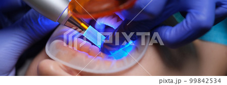 Doctor dentist illuminating filling with modern light lamp in clinic closeup 99842534