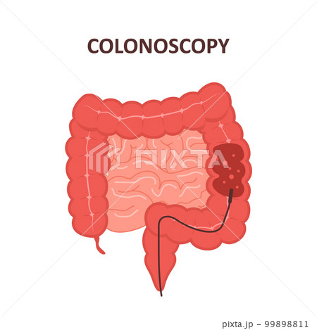 Colonoscopy procedure. Intestine exam and treatment. Colon polypectomy concept. Prevention of cancer. Vector illustration in flat cartoon style 99898811