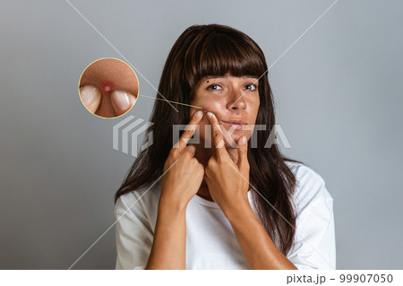 Acne and cosmetology. A tanned young woman squeezes a pimple on her face. Enlarged picture of a pimple Acne and cosmetology. A tanned young woman squeezes a pimple on her face. Enlarged picture of a pimple 99907050