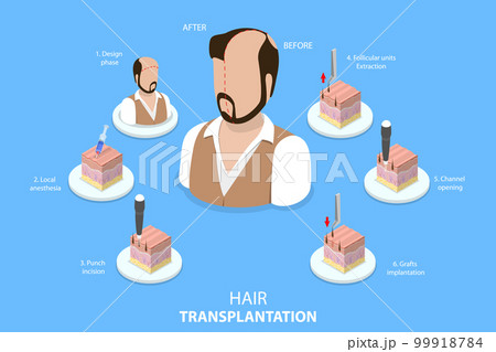 3D Isometric Flat Vector Conceptual Illustration of Hair Transplantation 99918784