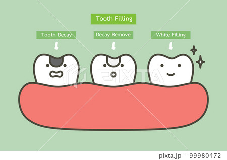 step of tooth amalgam filling by dental tools to protection decay tooth, before and after - teeth cartoon vector flat style 99980472