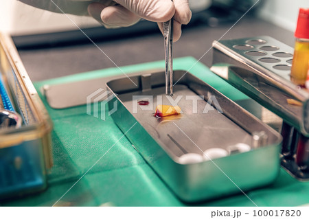 Platelet rich fibrin therapy 100017820