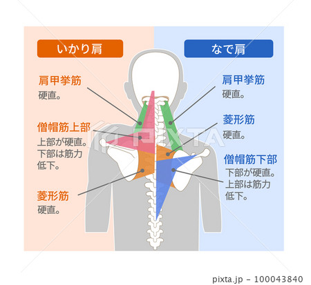 いかり肩となで肩の筋肉の構造 いかり肩となで肩の筋肉の構造 100043840