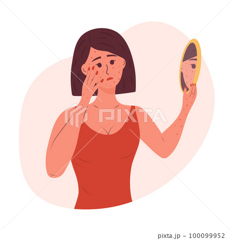 Sad woman with a rash on her face and hands looks in the mirror. Monkeypox virus , allergic itch, skin inflammation, redness, irritation, psoriasis, atopic dermatitis, eczema. Health and medicine conc 100099952