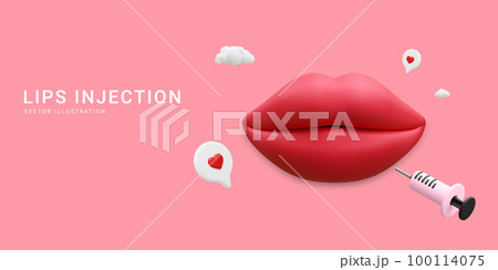 3d realistic banner for lip injection. Concept of dermatology and cosmetology treatment. Red aesthetic beautiful lips with medical plastic syringe with cosmetic injection in cartoon style 100114075