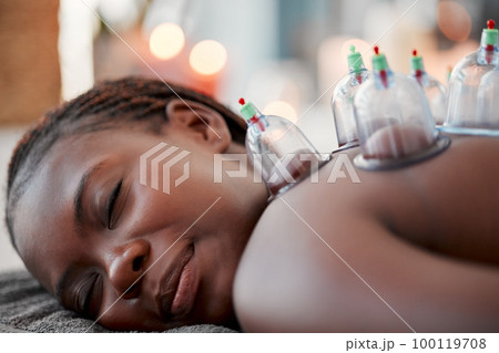 Black woman, face and smile in cupping therapy on back for pain relief, relaxation or blood flow at resort. Happy African American female smiling in relax for glass vacuum cups in deep tissue massage 100119708