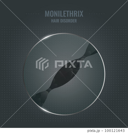 Monilethrix hair brittle disorder in close up 100121643
