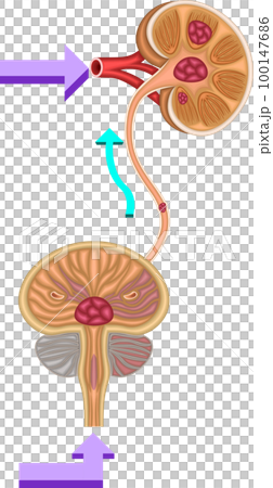 Bladder urinary stone illustration Bladder urinary stone illustration 100147686