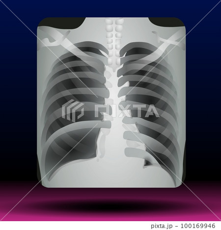 Chest X-ray Scan  100169946