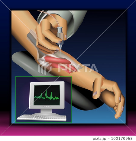 EMG Testing EMG Testing 100170968