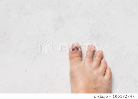 close-up of big toe with Subungual hematoma. Healthcare, pain. close-up of big toe with Subungual hematoma. Healthcare, pain. 100172747