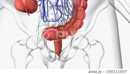 Colorectal cancer (CRC) is a common colon or rectal cancer that affects many patients over middle age. 100211007